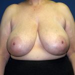 Breast Reduction Before & After Patient #3398