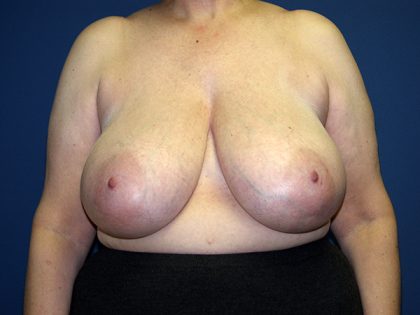 Breast Reduction Before & After Patient #3398