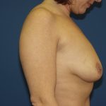 Breast Lift with Implant Before & After Patient #1558