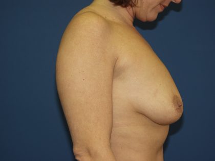 Breast Lift with Implant Before & After Patient #1558