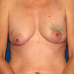 Breast Reconstruction Before & After Patient #2130