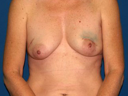 Breast Reconstruction Before & After Patient #2130