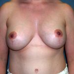 Breast Lift with Implant Before & After Patient #1495