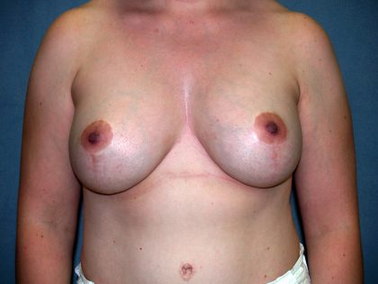 Breast Lift with Implant Before & After Patient #1495