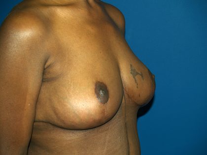 Breast Reduction Before & After Patient #3255