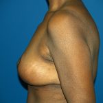 Breast Reduction Before & After Patient #3255