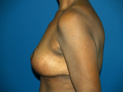 Breast Reduction Before & After Patient #3255