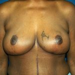 Breast Reduction Before & After Patient #3255