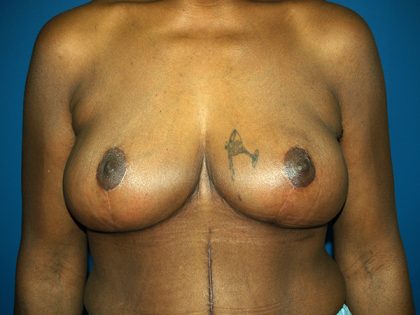 Breast Reduction Before & After Patient #3255