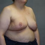 Breast Reconstruction Before & After Patient #1846