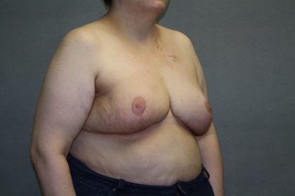 Breast Reconstruction Before & After Patient #1846