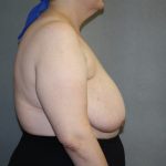 Breast Reconstruction Before & After Patient #1846