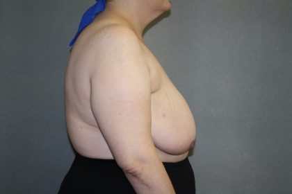 Breast Reconstruction Before & After Patient #1846
