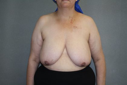 Breast Reconstruction Before & After Patient #1846