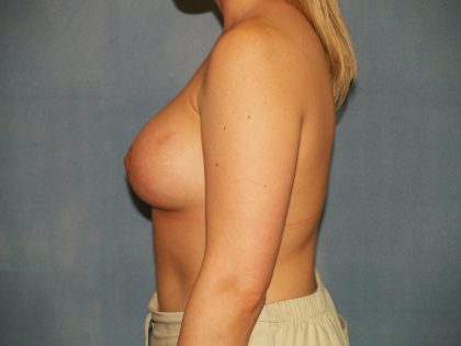 Breast Lift with Implant Before & After Patient #1439