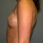 Breast Reconstruction Before & After Patient #1711