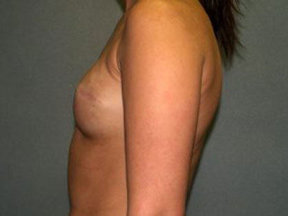 Breast Reconstruction Before & After Patient #1711