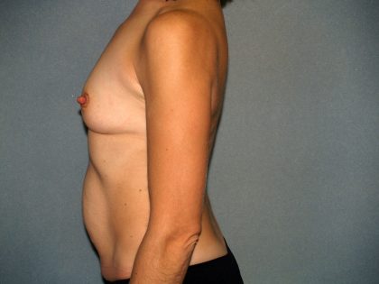 Breast Reconstruction Before & After Patient #1920