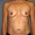 Breast Reconstruction Before & After Patient #1920