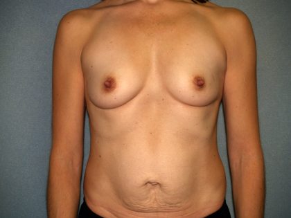 Breast Reconstruction Before & After Patient #1920