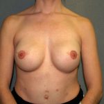 Breast Reconstruction Before & After Patient #1920