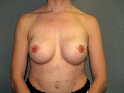 Breast Reconstruction Before & After Patient #1920