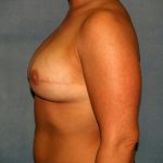 Breast Reconstruction Before & After Patient #2116