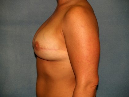 Breast Reconstruction Before & After Patient #2116
