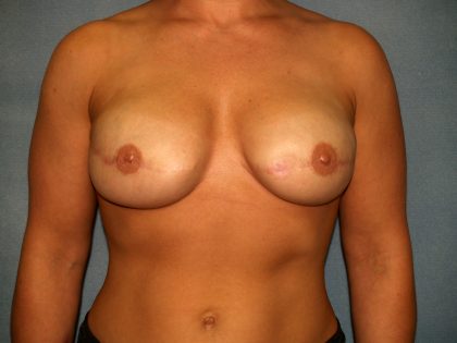Breast Reconstruction Before & After Patient #2116