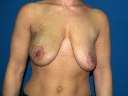 Breast Reconstruction Before & After Patient #2116