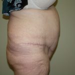 Tummy Tuck Before & After Patient #2047