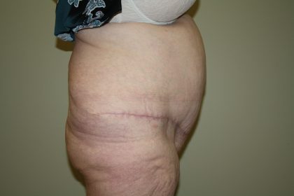 Tummy Tuck Before & After Patient #2047