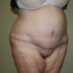 Tummy Tuck Before & After Patient #2047