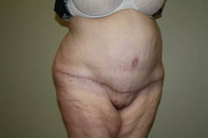 Tummy Tuck Before & After Patient #2047