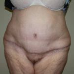 Tummy Tuck Before & After Patient #2047