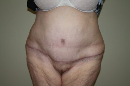 Tummy Tuck Before & After Patient #2047