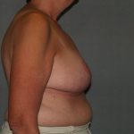 Breast Reduction Before & After Patient #3441