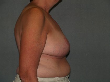 Breast Reduction Before & After Patient #3441