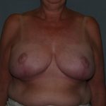 Breast Reduction Before & After Patient #3441