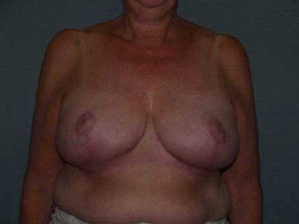 Breast Reduction Before & After Patient #3441