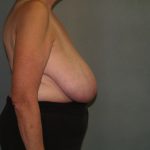 Breast Reduction Before & After Patient #3441