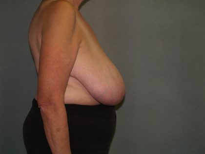 Breast Reduction Before & After Patient #3441