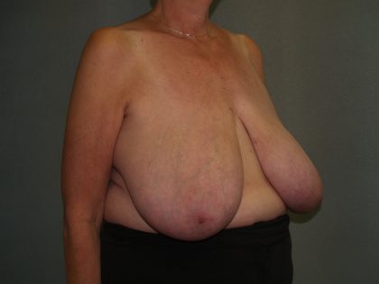 Breast Reduction Before & After Patient #3441