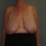 Breast Reduction Before & After Patient #3441