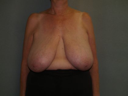 Breast Reduction Before & After Patient #3441