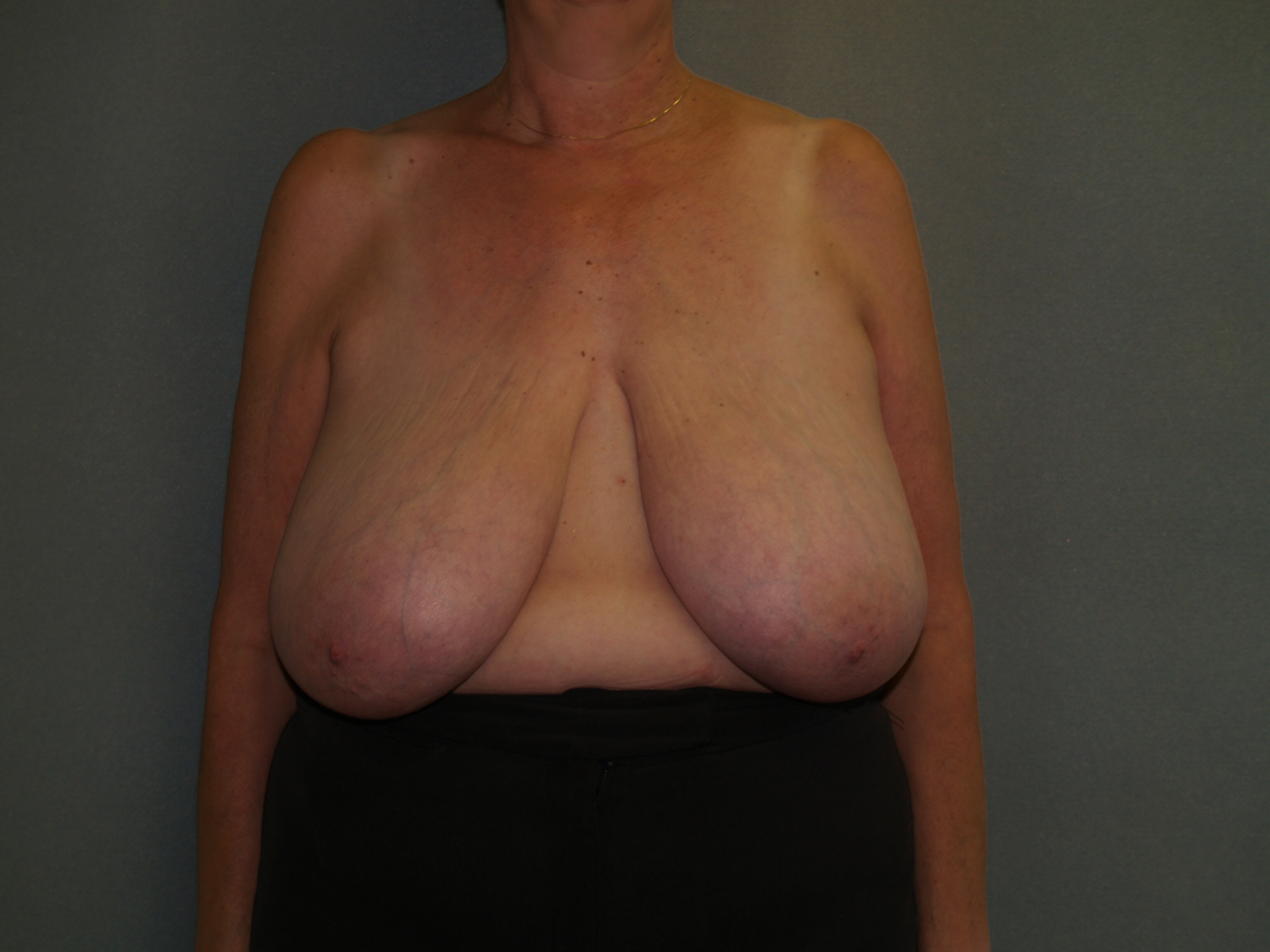 Breast Reduction Before & After Patient #3441