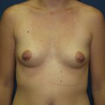 Breast Augmentation Before & After Patient #2433