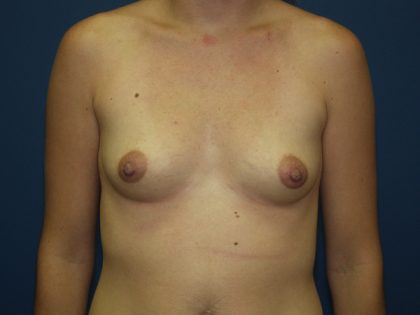 Breast Augmentation Before & After Patient #2433