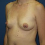 Breast Augmentation Before & After Patient #2433