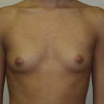 Breast Augmentation Before & After Patient #2710